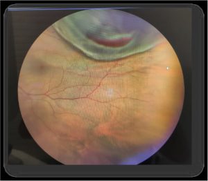 Doctor Álvaro de Casas - oftalmólogo -Desprendimiento de retina